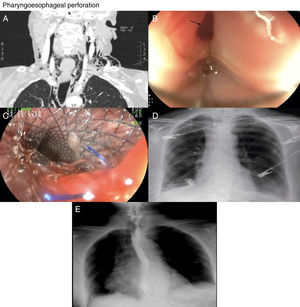 Pharyngoesophageal perforation. (A) CT scan of the neck with contrast: grey arrows showing evidence of subcutaneous emphysema and pneumomediastinum. (B) Black arrow indicating endoscopic evidence of hole in pharyngoesophageal region. (C) Endoscopic view of a metal stent in the pharyngoesophageal region. (D) Grey arrow showing radiological image of the stent in the cervical/thoracic region. (E) Oesophagogram: normal, with no evidence of contrast extravasation.