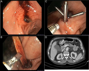 (A) Endoscopic image of a foreign body (FB) with a pointed end embedded in the gastric wall with a clot attached. (B) Extraction of the FB with crocodile forceps, discovering that it was a toothpick. (C) Placement of 3 haemostatic clips over the wound. (D) CT scan of the abdomen showing extraluminal air bubbles and inflammatory signs in the gastric wall.