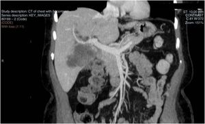 CT of abdomen: mass in liver segments IV and V.