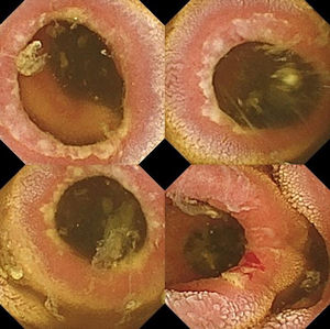 Images of the endoscopic capsule as it passes through the jejunum, in which multiple fibrous rings with ulcerated edges are visualised, some with traces of fresh blood. The rings are narrowing the lumen, but allowing the passage of the capsule.