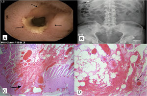 (A) Capsule endoscopy showing severe stenosis, with fibrotic appearance, ulcerated and covered with fibrin. (B) Simple X-ray of abdomen: retained capsule on day three post-ingestion. (C and D) Fibrotic ulcer with submucosal, serous inflammation, severe vascular congestion and hypertrophy of the muscular layer.