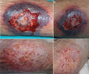 Pyoderma gangrenosum: macroscopic appearance after 1 week (A: right leg and B: left leg) and 3 weeks (C: right leg and D: left leg) of systemic corticosteroid therapy.