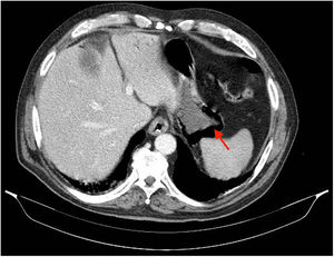 Gastric pneumatosis (red arrow).