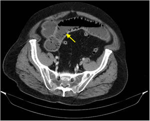 Intestinal pneumatosis (yellow arrow).