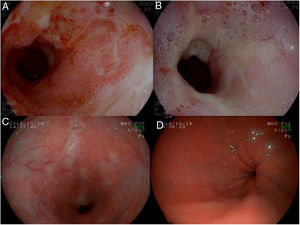 (A and B) Initial gastroscopy. Stenosis of 3–4cm in length that is easily passed with the endoscope, with the presence of fibrinous ulcers around the whole circumference (A) and two areas of raised mucosa and adenomatous appearance (B). (C and D) Control gastroscopy at 12 months from the surgery, with no evidence of lesions.