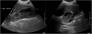 Ultrasound image showing a distended gallbladder of 15 × 6 cm, with abundant heterogeneous intravesicular content, with no clear image of cholelithiasis and without dilation of the bile duct.