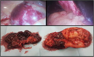 Macroscopic appearance of the gallbladder during laparoscopic surgery and the extracted tissue, displaying thickened walls with a necrohaemorrhagic appearance and many clots in the lumen, matching the heterogeneous content described in the ultrasound.
