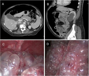 Axial (A) and sagittal (B) slices of the axial CT of the abdomen and pelvis with intravenous contrast; abundant pneumoperitoneum and thickening of the walls of the small intestine with unstructured wall at the jejunum. The intraoperative exploratory laparoscopy images (C and D) show multiple subserous air cysts in the wall of the small intestine.