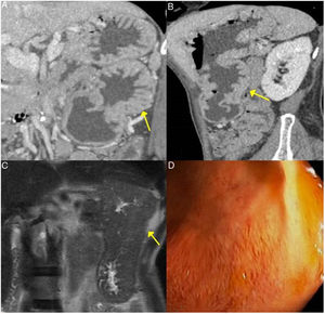 Gastric IgG4-RD. A and B) CT scan images, coronal and sagittal reconstruction respectively: an increase in gastric size with large, thick folds (arrows) is observed. C) MRI image, coronal enhanced sequence in T2: thickening of gastric folds with marked decrease in the gastric lumen is observed. D) Gastroscopy image: mucosal hypertrophy with prominent vascularisation is observed.