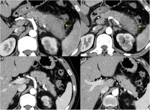 Remission of focal type 1 AIP of the pancreatic tail after corticosteroid treatment. A and B) CT scan images of a patient with focal pancreatitis of the pancreatic tail (arrows) with increased focal size, loss of pancreatic clefts and characteristic peripheral hypodense halo, in the context of an IgG4-RD. C and D) CT scan images at 3 months after the patient received corticosteroid treatment: complete resolution of the focal involvement of the pancreatic tail is observed, which is shown to be of normal size and with normal pancreatic clefts preserved.