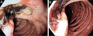 A and B) Deep ulcer with an infiltrative appearance in the distal duodenum.