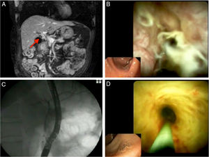 (A) Magnetic resonance cholangiopancreatography showing the absence of representation of the common bile duct with contrast enhancement adjacent to its path. (B) First cholangioscopy: image of the common bile duct showing an epithelium with an inflammatory appearance, with diffuse erythema, a papillary–granular pattern and dilated, tortuous vessels. (C) Normal cholangiogram following treatment with corticosteroids. (D) Cholangioscopic image of the common bile duct following treatment showing a “honeycomb” pattern with depressed areas having a fibrotic appearance resulting from scarring.