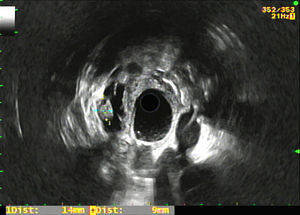 Radial endoscopic ultrasound image of a 28×12mm head of pancreas cyst with a 14×9mm hyperechogenic nodule in its interior plus septation.