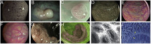 Images of polyps with different endoscopic technologies. A) Adenoma with high-grade dysplasia corresponding to category IV of the Teixeira classification for Flexible spectral imaging colour enhancement (FICE). Many long, spiriform vessels can be seen, some thicker and with disperse dilations. B) i-SCAN image (mode 3, demarcation) of a non-adenomatous colon polyp, pale in colour, similar to the surrounding mucosa. C) Mode 3 of i-SCAN Optical enhancement (OE) of a diminutive colon adenoma, which provides optical improvement of the vascular characterisation. Representative case of sessile serrated polyp in Blue Laser Imaging-Bright (BLI-Bright) mode D) and Linked Colour Imaging (LCI) mode E). F) Also with LCI, two adenomas with flat-elevated diminutive low-grade dysplasia (Paris IIa) of sigmoid colon. G) Image in Blue Light Imaging (BLI) mode of 10mm flat-elevated colon adenoma with low-grade dysplasia (courtesy of H. Uchima). H) Image of an adenomatous polyp of granular laterally spreading tumour (G-LST) of 5cm in caecum; with autofluorescence (AFI) the lesion appears purple, which contrasts with the normal surrounding mucosa, which is green. I) Hyperplastic polyp visualised by laser confocal endomicroscopy (iCLE) in which the crypts have regular openings with a homogeneous epithelial cell layer. J) Example of colon polyp with high-grade dysplasia and viewed by endocytoscopy with 450x magnification; the glands are irregularly shaped with large and distorted nuclei (category 2).