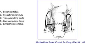 Parks classification of fistulas.