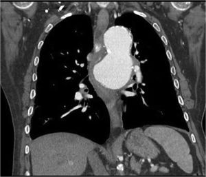 Coronal section CT, arterial phase.