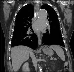 Coronal section CT, late phase.