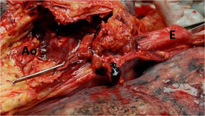 Aortoesophageal fistula in autopsy. Ao: aorta; E: oesophagus.