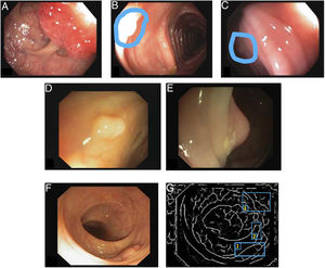 Special features of endoscopic images with an impact on image processing analysis. Examples of effects of lighting: (A) specular reflections; (B) over-exposed polyp; and (C) under-exposed polyp. The polyps in images (B) and (C) are delimited with a blue mask to facilitate visualisation. Variability in polyp appearance: (D) frontal view; (E) lateral view. Example of similarity of response of different structures (F and G). The number “1” represents a polyp, the number “2” represents a fold and the number “3” represents several blood vessels.