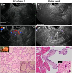 Iconographic features of both clinical cases. (A and B) EUS showing the pancreatic solid head mass with positive Doppler flow in case 1. (C) Surgical pathology after resection which confirms the diagnosis of SSCA. (D and E) EUS showing the pancreatic solid head mass before and during FNB in case 2. (F) Cellblock confirming the diagnosis of SSCA in case 2.