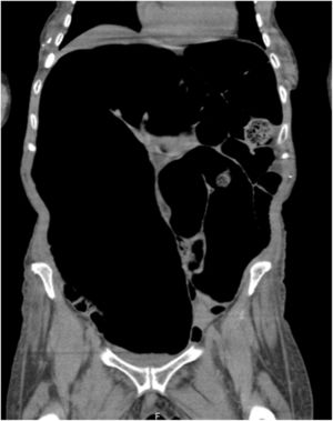 Computed tomography revealing marked distension of the sigmoid colon and rectum without any identified anatomic lesion, compatible with pseudo-obstruction.