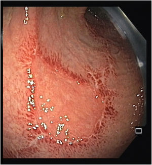 Triangular-shaped ulcer with approximately 20mm; the results of PCR testing on biopsies were positive for varicella-zoster virus.
