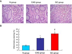 HE staining for inflammation in the tumor tissues of gastric cancer patients. (A) HE staining images for the inflammation. (B) Statistical analysis for the HE staining results. *p<0.05 vs. N group, #p<0.05 vs. CAG group. Magnification, 400×.