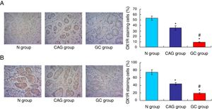Immunohistochemistry assay for evaluating OX1R and OX2R expression in the tumor tissues of gastric cancer patients. (A) Evaluation for OX1R expression in tumor tissues. (B) Evaluation for OX2R expression in tumor tissues. *p<0.05 vs. N group, #p<0.05 vs. CAG group. Magnification, 400×.