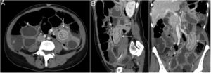 Abdominal CT scan showing ilio-ileal intussusception (arrows) in transverse (A), sagittal (B) and coronal (C) planes, with marked distension of proximal loops and pneumatosis intestinalis (asterisks).