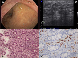 (A) Endoscopic image showing marked erythema of the ileocecal valve and eodema and loss of vascular pattern of the cecum mucosa. (B) Histopathology of biopsies from the ileocecal valve showing poorly cohesive tumor cells in lamina propria and signet ring cells, 200×. (C) Positive immunohistochemistry for estrogen receptor. (D) Breast ultrasound image showing a hypoechoic nodule with posterior acoustic shadowing.