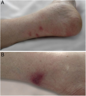 (A) Clinical image of the posterior aspect of the left ankle. Three erythematous nodular lesions can also be seen. (B) Clinical image of the posterior aspect of the right leg, showing an erythematous nodular lesion 19mm×15mm in size.