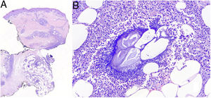 (A) Histopathological study of the lesion on the posterior aspect of the right leg. The image shows predominant involvement of the panniculus adiposus, with predominantly lobular panniculitis (H&E 1.9×). (B) Histopathological study of the lesion on the posterior aspect of the right leg at higher magnification. The image shows the presence of “ghost areas” with anucleated adipose cells intermingled with amorphous granular tissue with intense basophilia (H&E 24.5×).