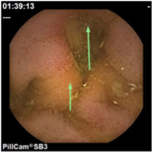 Capsule endoscopy image showing ulcerated stenosis (arrows).