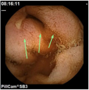 Capsule endoscopy image showing the same lesion six months later, with a significant increase in the degree of stenosis (arrows).