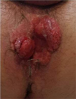 Hard, painful, fungating tumour in the perianal region on dystrophic skin, approximately 10cm long, with small superficial erosions.