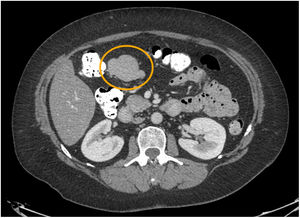 Abdominal CT scan showing cystic mass measuring approximately 7 cm.