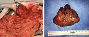 Intraoperative finding and surgical specimen from the lesion located in the omental bursa.