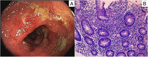 A) Oedematous and erythematous sigmoid mucosa, with loss of vascular pattern, purulent exudate and fibrin-covered superficial ulcers. B) Diffuse increase in mononuclear inflammatory infiltrate in the lamina propria of the rectal mucosa, with cryptitis and microabscesses and crypt architectural distortion, respecting the muscularis mucosae.