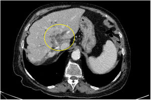 Computed tomography image showing bilateral intrahepatic biliary tract dilation and the area of the associated mass effect in the hilum suggestive of malignancy (yellow circle).