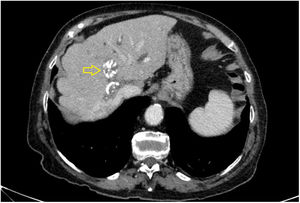 Computed tomography image showing 2 round calcified lesions suggestive of hydatid cysts (yellow arrow).