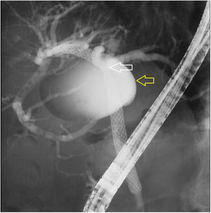 Endoscopic retrograde cholangiopancreatography image showing a cystic lesion which filled with contrast (yellow area) fistulised to the biliary tract, causing stenosis (white arrow), for which reason an uncoated metal biliary stent with a length of 8 cm and a calibre of 1 cm was placed and drainage was confirmed.