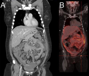 A: CT scan of the chest, abdomen and pelvis: peritoneal carcinomatosis, moderate intra-abdominal ascites, pathological lymphadenopathy in the right cardiophrenic angle and bilateral pulmonary micronodules. B: PET/CT scan: peritoneal and hepatic pericapsular carcinomatosis with multiple instances of supra- and sub-diaphragmatic lymphadenopathy and probable pleural implants.