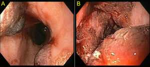 Gastroscopy identifying multiple vesicles (A) with ulcerated mucosa in the inferior third of the oesophagus (B).
