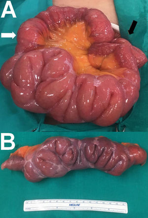A. Segment of middle jejunum measuring 50-60 cm with multiple firm adhesions resulting in several bends interfering with bowel transit. The afferent loop (white arrow) and the efferent loop (black arrow) are visible. B. Bowel resection specimen from the affected segment showing multiple fibrous adhesions resulting in several bends.