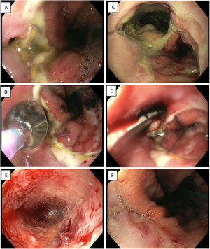 Endoscopic vacuum therapy in anastomotic surgical wound dehiscence following Ivor Lewis surgery. A) Small anastomotic defect. B) Balloon dilation of the opening of the dehiscence. C) Access to infected cavity. D) Insertion of Eso-SPONGE. E) Cleaning of the cavity and formation of granulation tissue (image following 3rd sponge change). F) Resolution of anastomotic dehiscence (after 6 sponges).