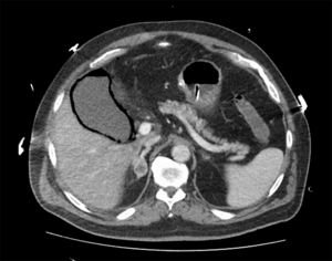 Axial Abdominal computed tomography presented gas in the wall of the gallbladder with air in the lumen.