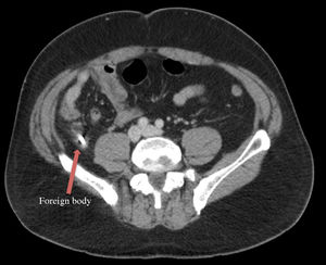 Abdominal CT scan: a metallic foreign body can be seen in the caecal appendix with associated inflammatory changes consistent with acute appendicitis.