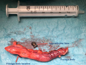 Surgical specimen: a caecal appendix is observed with an incision in its distal third from which a metallic foreign body (buckshot) was removed.