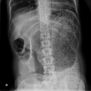 Abdominal X-ray: significant dilation of loops with breadcrumb pattern occupying the entire abdomen, rendering it impossible to rule out a gastric origin. No signs of pneumoperitoneum.