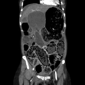 CT scan: marked dilatation of the intestinal loops in the small intestine together with pneumatosis, with preserved mural enhancement. A change in calibre is observed in the right flank with engorgement of vessels associated with this level, without pneumoperitoneum.